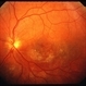 CMV Retinitis
